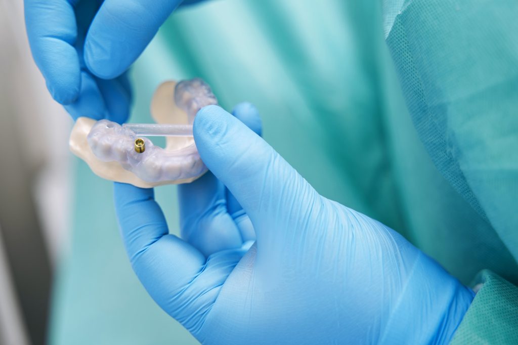Doctor hands holding teeth model with dental implant